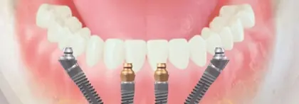 Lucrare dentară fixă ancorată pe 4 implanturi