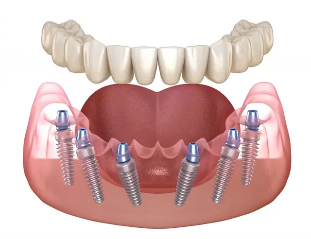 Ilustrație: lucrare dentară fixă ancorată pe implanturi inserate în maxilar