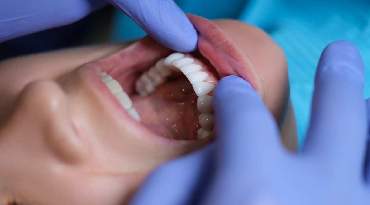 fatetele dentare: tipuri, avantaje si tratament