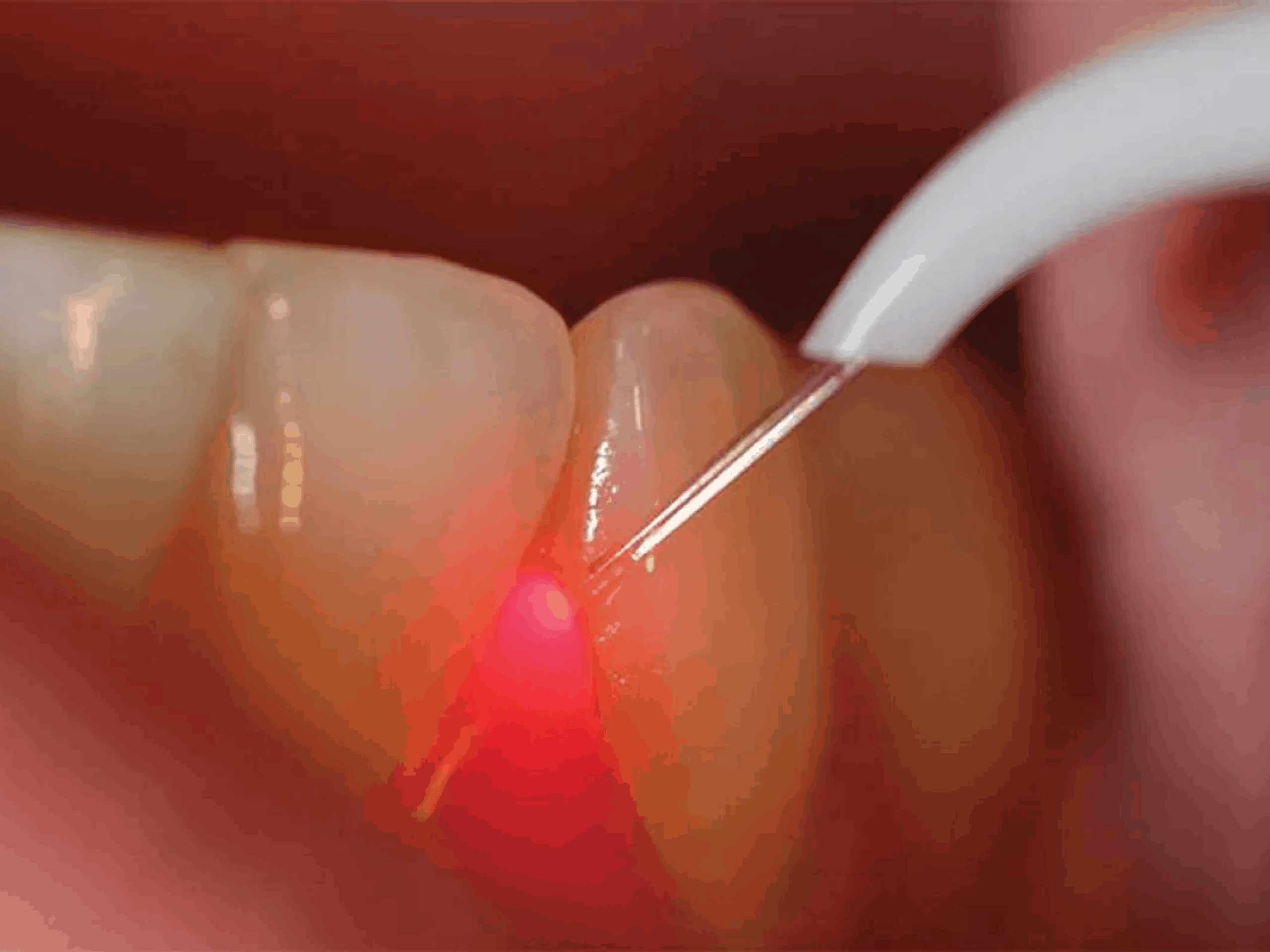 Tratamentul parodontozei cu laser