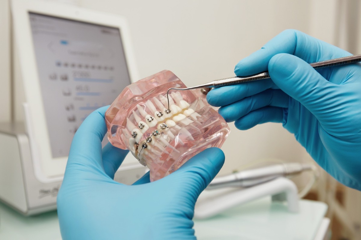 Sfaturi de îngrijire a aparatelor dentare
