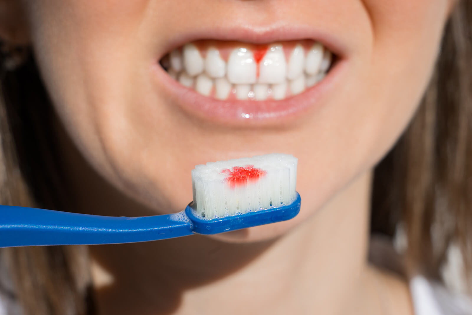 Sangerarea gingiilor | Sangerari gingivale cauze