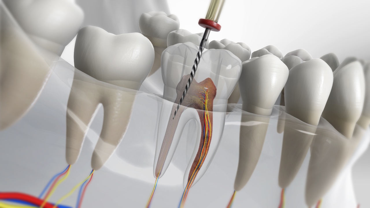 semne ca ai nevoie de un tratament endodontic