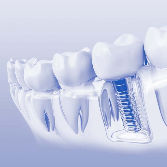 mituri despre implantul dentar