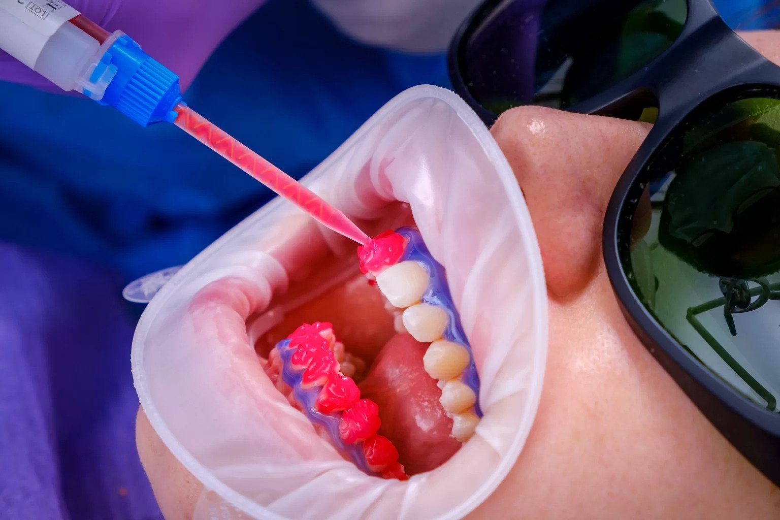 miturile despre albirea dentara